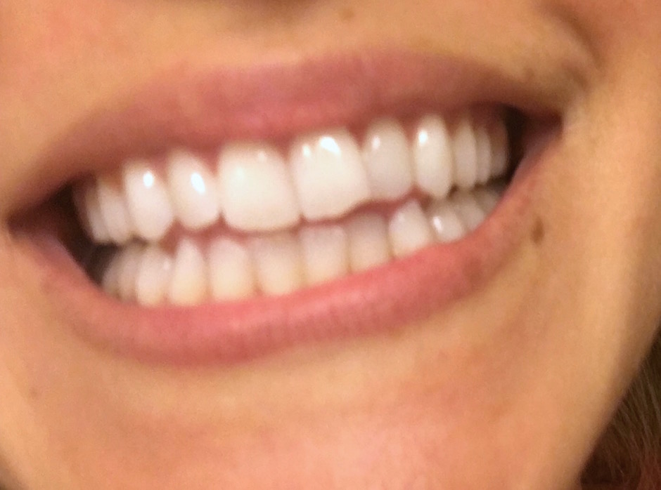 Smile Brilliant Teeth Whitening before